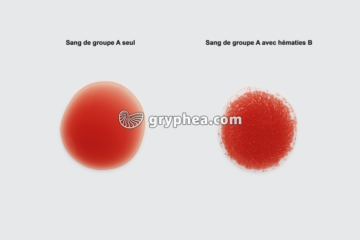 Agglutination entre sang de groupe A et sang de groupe B - gryphea.com